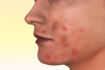 Контактный дерматит Проявление аллергии на пасту