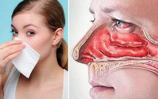 Нарушена дыхательная функция Отек слизистой носа