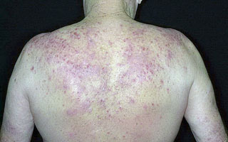 Экзематозные высыпания на спине Виды болезни