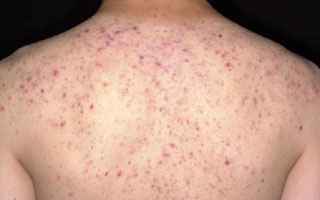 Проявления экземы на спине Экзема на спине