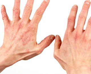 Густая сыпь - основной признак реакции Красная сыпь на руках