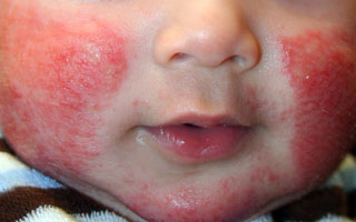 Сыпь и покраснение у ребенка Признаки дерматита