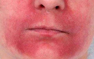 Розацеоподобный дерматит у взрослого Розацеоподобный дерматит