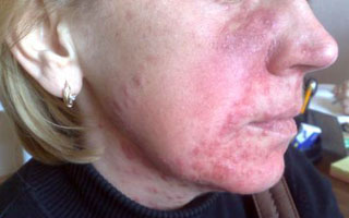 Стероидный дерматит на лице Стероидный дерматит