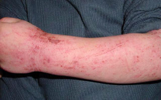Зудящий дерматит на руке Зудящий дерматит