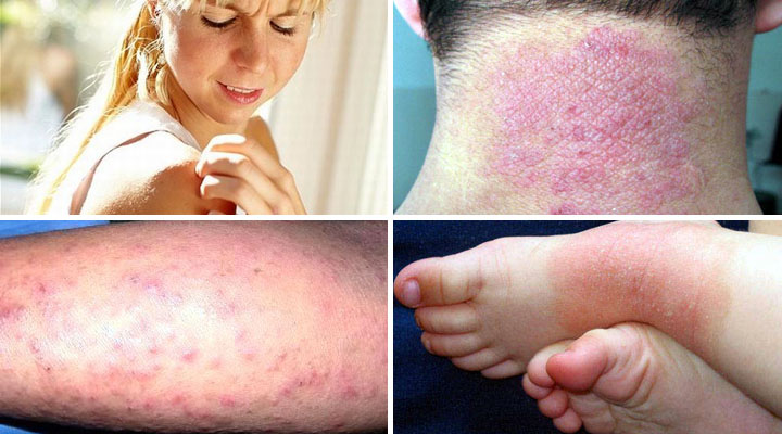 Проявления зудящего дерматита Проявления болезни